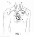Fig. 02 - MRI compatible tachycardia lead