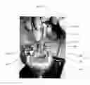 Fig. 04 - Inflatable minimally invasive system for delivering and securing an annular implant