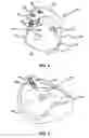 Fig. 05 - ARTIFICIAL JOINT PRESERVING TENDON AND/OR SESAMOID BONE STRUCTURE