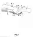 Fig. 08 - ARTIFICIAL JOINT PRESERVING TENDON AND/OR SESAMOID BONE STRUCTURE