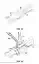 Fig. 12 - ARTIFICIAL JOINT PRESERVING TENDON AND/OR SESAMOID BONE STRUCTURE