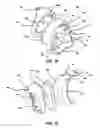Fig. 15 - ARTIFICIAL JOINT PRESERVING TENDON AND/OR SESAMOID BONE STRUCTURE