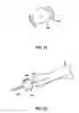 Fig. 18 - ARTIFICIAL JOINT PRESERVING TENDON AND/OR SESAMOID BONE STRUCTURE