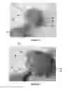 Fig. 04 - System of orienting femoral head for acetabular prosthesis alignment