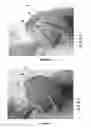 Fig. 05 - System of orienting femoral head for acetabular prosthesis alignment