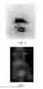 Fig. 05 - RADIOLABELING METHOD USING MULTIVALENT GLYCOLIGANDS AS HEPATIC RECEPTOR IMAGING AGENT
