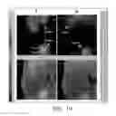 Fig. 09 - RADIOLABELING METHOD USING MULTIVALENT GLYCOLIGANDS AS HEPATIC RECEPTOR IMAGING AGENT