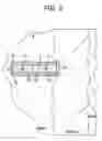Fig. 04 - Methods and devices for correcting spinal deformity with pharmaceutical-eluting pedicle screws