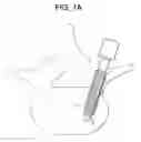 Fig. 02 - Methods and devices for correcting spinal deformity with pharmaceutical-eluting pedicle screws
