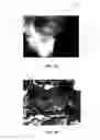 Fig. 04 - Conformable tissue repair implant capable of injection delivery