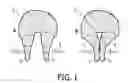 Fig. 02 - Device and Method for Pinching at Least Two Dough Parts