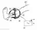 Fig. 01 - Apparatus for Stimulating a Healing Process in the Region of an Implant