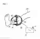Fig. 02 - Apparatus for Stimulating a Healing Process in the Region of an Implant