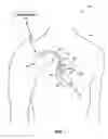 Fig. 02 - Method of using a deflectable subselecting catheter