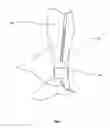 Fig. 05 - Method and apparatus for diagnosing and treating vascular disease
