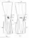 Fig. 02 - Cable Knee Brace System