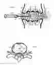 Fig. 04 - Internal and external disc shunts alleviate back pain