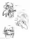 Fig. 05 - Internal and external disc shunts alleviate back pain