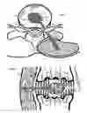 Fig. 13 - Internal and external disc shunts alleviate back pain
