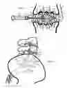 Fig. 16 - Internal and external disc shunts alleviate back pain