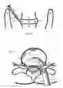 Fig. 17 - Internal and external disc shunts alleviate back pain