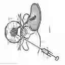 Fig. 24 - Internal and external disc shunts alleviate back pain