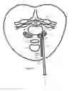 Fig. 25 - Internal and external disc shunts alleviate back pain
