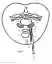 Fig. 26 - Internal and external disc shunts alleviate back pain