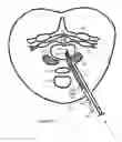 Fig. 28 - Internal and external disc shunts alleviate back pain