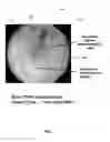 Fig. 07 - Visual indication of rupture of drug reservoir