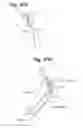 Fig. 35 - Devices And Methods For Minimally Invasive Access To Sinuses And Treatment of Sinusitis