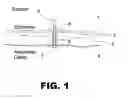 Fig. 02 - Directly insertable laparoscopic closure device, hemostasis and drain
