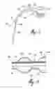 Fig. 06 - CATHETER DEVICE FOR THE CONTROL OF LIQUID DISCHARGE FROM THE URINARY BLADDER BY A USER PERSON