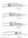 Fig. 08 - Methods for removing kidney stones from the ureter