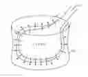 Fig. 01 - Vertebral body nerve and vein cauterizing system and method
