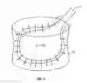 Fig. 02 - Vertebral body nerve and vein cauterizing system and method