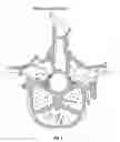 Fig. 04 - Vertebral body nerve and vein cauterizing system and method