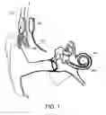 Fig. 02 - Cochlear implant with improved electrode array and controller