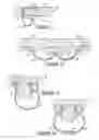 Fig. 09 - Soft tissue anchoring methods and devices
