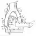 Fig. 01 - Methods and apparatus for vascular protection in spinal surgery