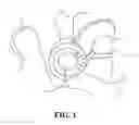 Fig. 02 - Methods and Apparatus For Treating Spinal Stenosis