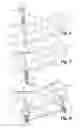 Fig. 03 - Method and apparatus for maxillo-mandibular fixation