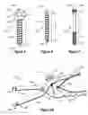 Fig. 03 - Methods for repairing bone discontinuities