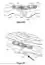 Fig. 07 - Methods for repairing bone discontinuities