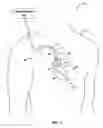 Fig. 02 - Non-sustained tachyarrhythmia analysis to identify lead related condition