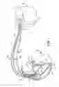 Fig. 02 - Minimum ventricular pacing to break the repetitive AR-VS pattern