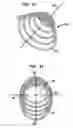 Fig. 10 - Collapsible and re-expandable prosthetic heart valve cuff designs and complementary technological applications