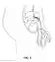 Fig. 04 - Occlusion implant