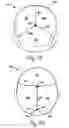 Fig. 06 - Lateral support craniocervical orthosis and method