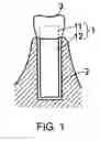 Fig. 02 - Dental implant